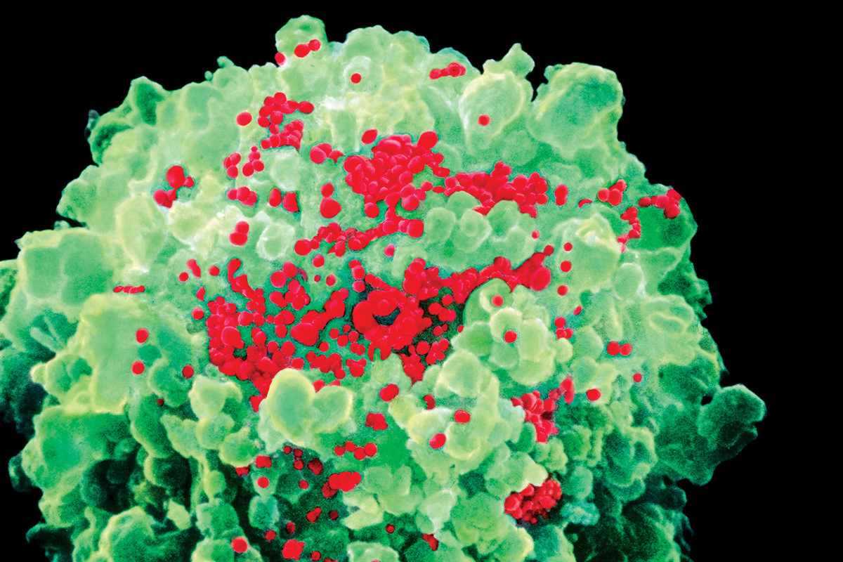 Иммунодефицит поражает. Вирус Эпштейна-Барр микроскоп. Вирус Эпштейна Барр иммунодефицит. Инфицированная клетка ВИЧ.