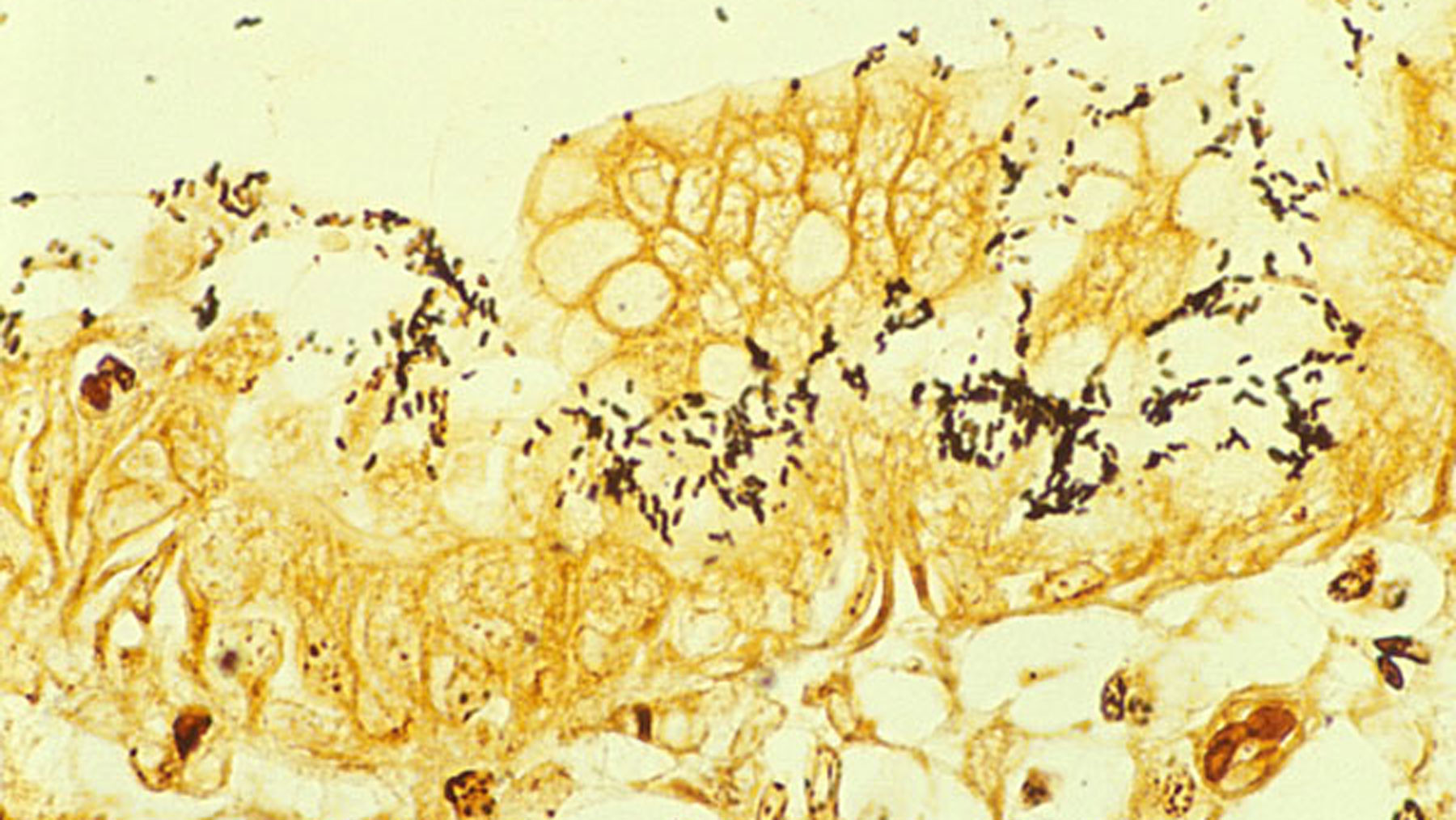 Гистологический препарат слизистой желудка, демонстрирующий хеликобактерный гастрит и колонизацию слизистой хеликобактером. Фото © Wikipedia