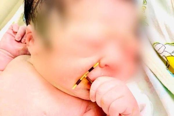 Младенец стал настоящим чудом, когда после родов в его руке нашли противозачаточную спираль