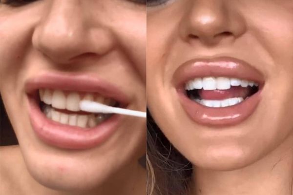 В TikTok придумали лайфхак, как быстро отбеливать зубы, но последствия будут необратимы