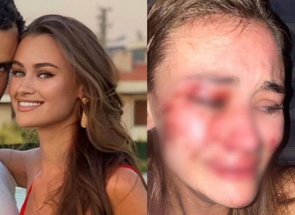 10 фото украинской модели, которая попала во все новости, рассказав, как её избили охранники в Турции