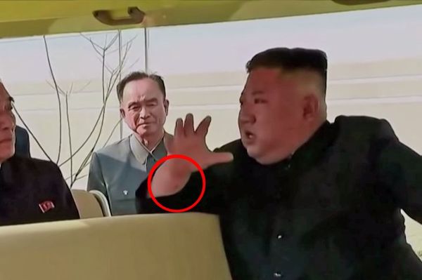 На руке Ким Чен Ына нашли странный след