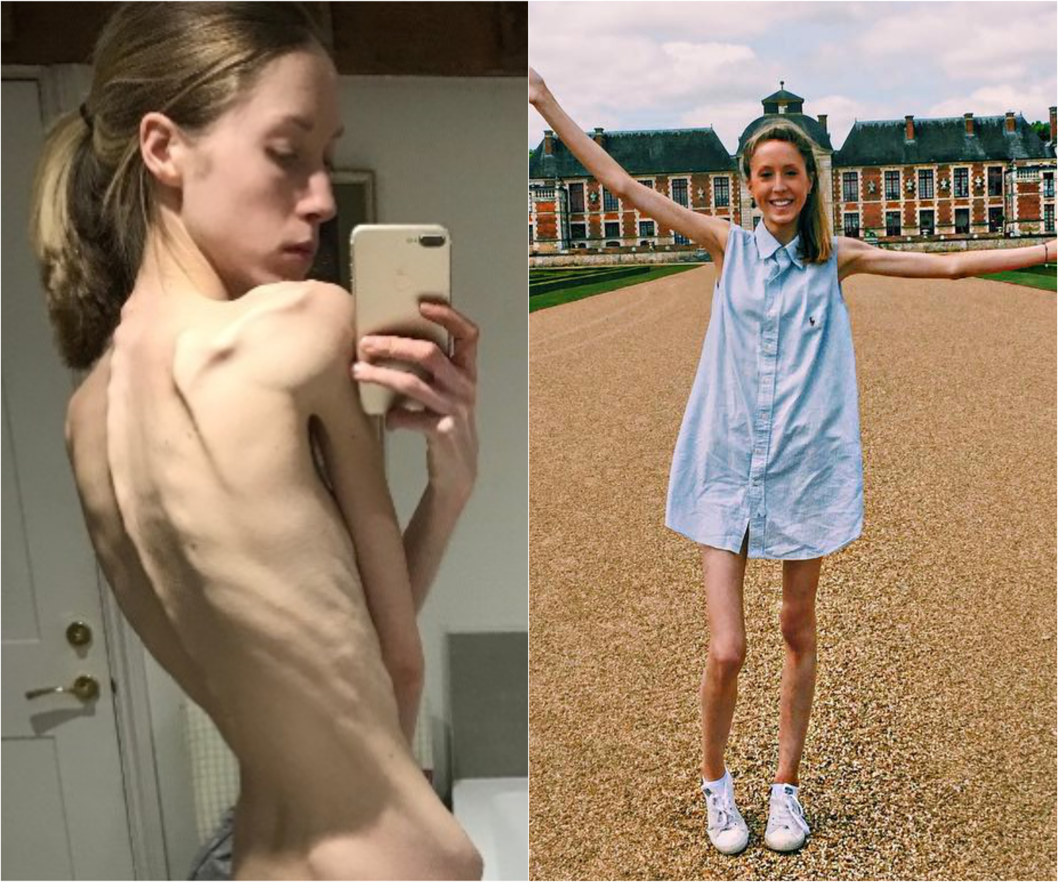 Фото до и после госпитализации. Фото © Instagram/jemimahepburn