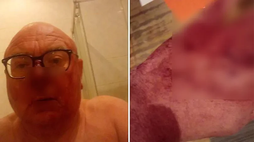 Павел Лобков после нападения. Обложка © Facebook (соцсеть запрещена в РФ; принадлежит корпорации Meta, которая признана в РФ экстремистской) / Павел Лобков