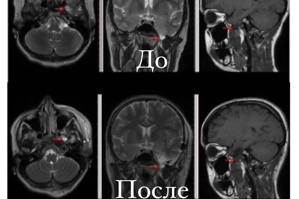 В Петербурге врачи прооперировали девушку с редкой патологией головного мозга. Фото © Telegram / Комздрав СПб