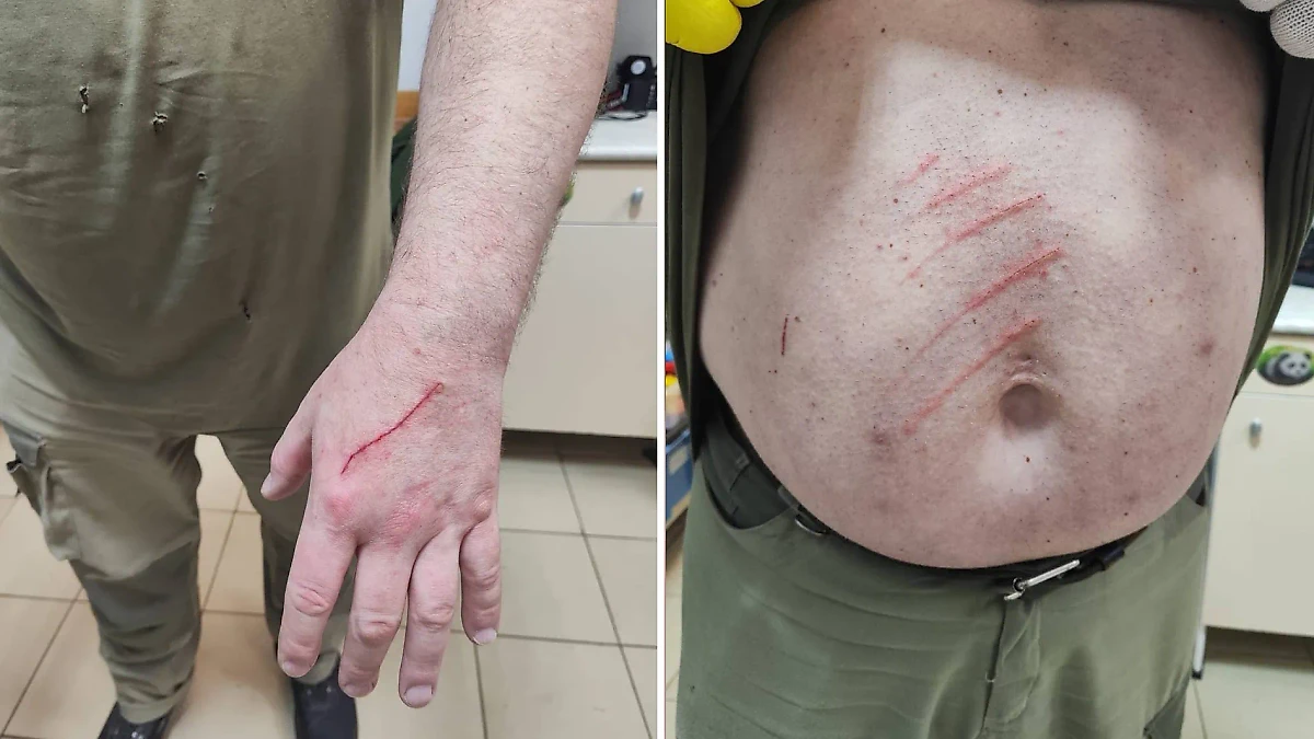 Так выглядят порезы, нанесённые пандой Катюшей сотруднику Московского зоопарка. Фото © Telegram / Светлана Акулова