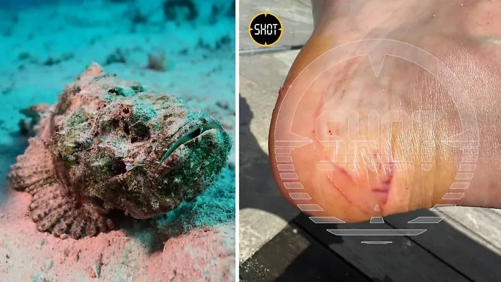 Бородавчатка и нога пострадавшего россиянина. Фото © ТАСС / DPA / Yannick Tylle / SHOT