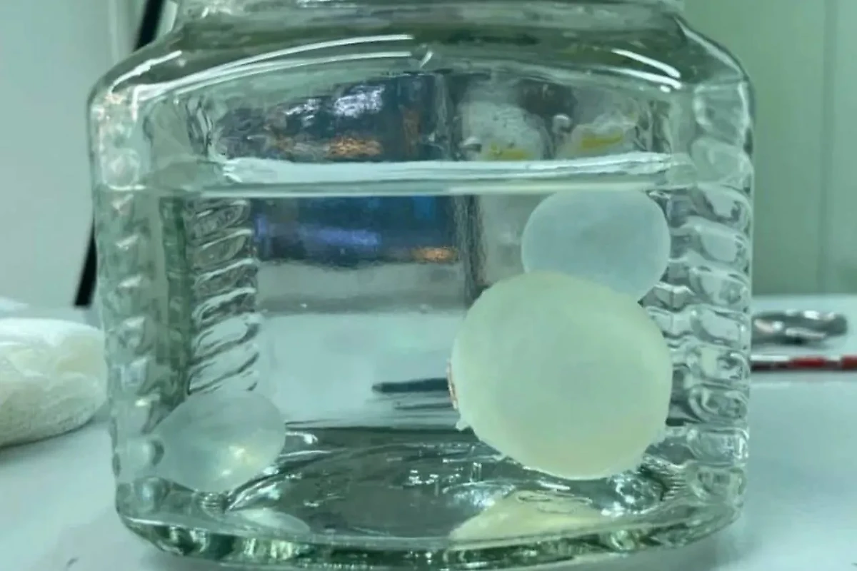 Личинки эхинококка, извлечённые из мозга 16-летней девушки. Обложка © Telegram / Doctor DAA