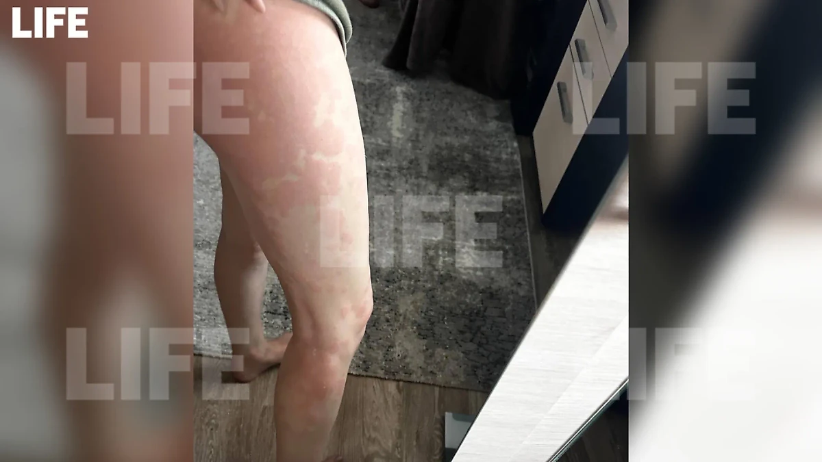 Красные пятна появились на теле у россиянки после того, как она уснула с никотиносодержащей пастилкой во рту. Фото © Life.ru