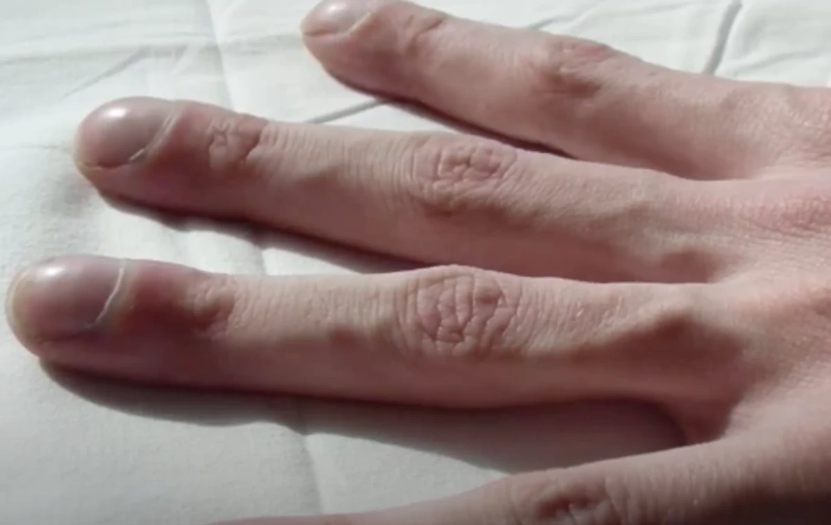 Барабанные палочки: серьёзные симптомы. Фото © Great History / Youtube