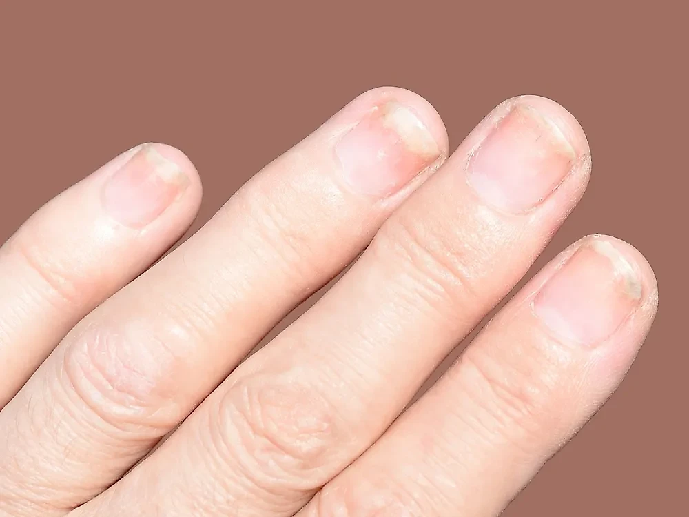 Ложковидные ногти: причины и решения. Фото © Shutterstock / FOTODOM / icjay17