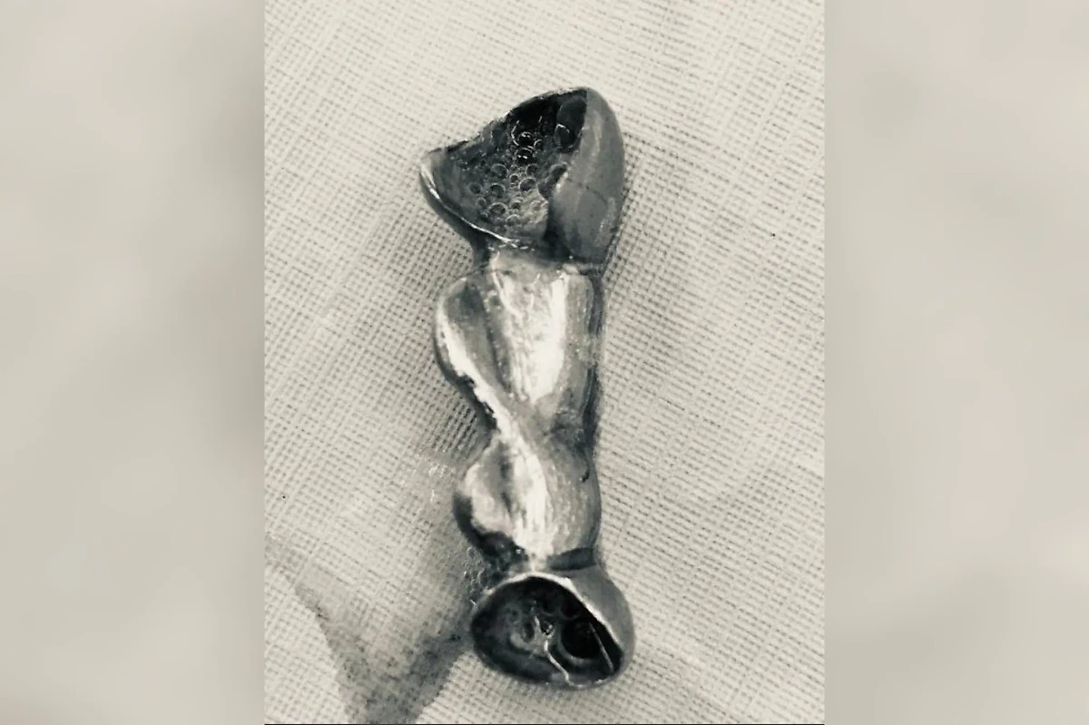 Подольские врачи спасли пациента, проглотившего зубной мост. Фото © Минздрав Московской области