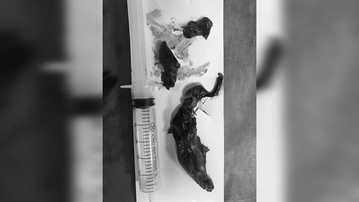 11-сантиметровый тромб, извлечённый из 76-летнего мужчины малоинвазивным методом. Фото © Минздрав Московской области