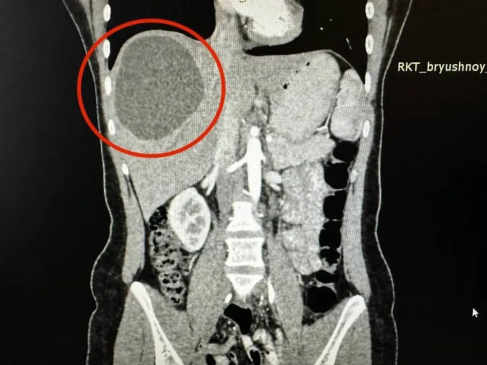 Киста в печени жительницы Казани. Обложка © VK / РКБ Татарстана