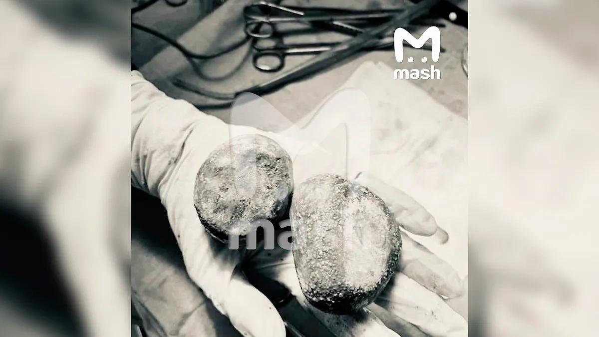 Камни-гиганты, которые врачи удалили из мочевого пузыря жительницы Подмосковья. Фото © Mash