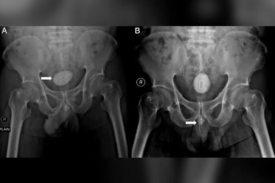 Рентгеновский снимок жителя Индонезии, который ввёл в уретру кабель и инструмент для извлечения сим-карты. Фото © sciencedirect.com