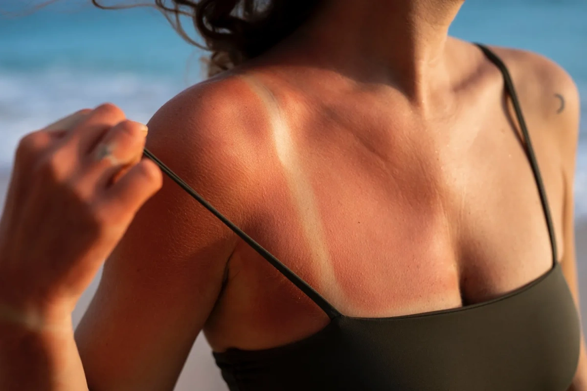 Опасность солнечных ожогов: как они влияют на здоровье кожи. Фото © Freepik