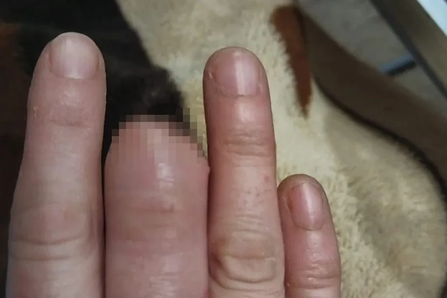 Россиянка судится с врачом из-за отказа пришивать отрезанный на шинковке палец. Обложка © Kp.ru