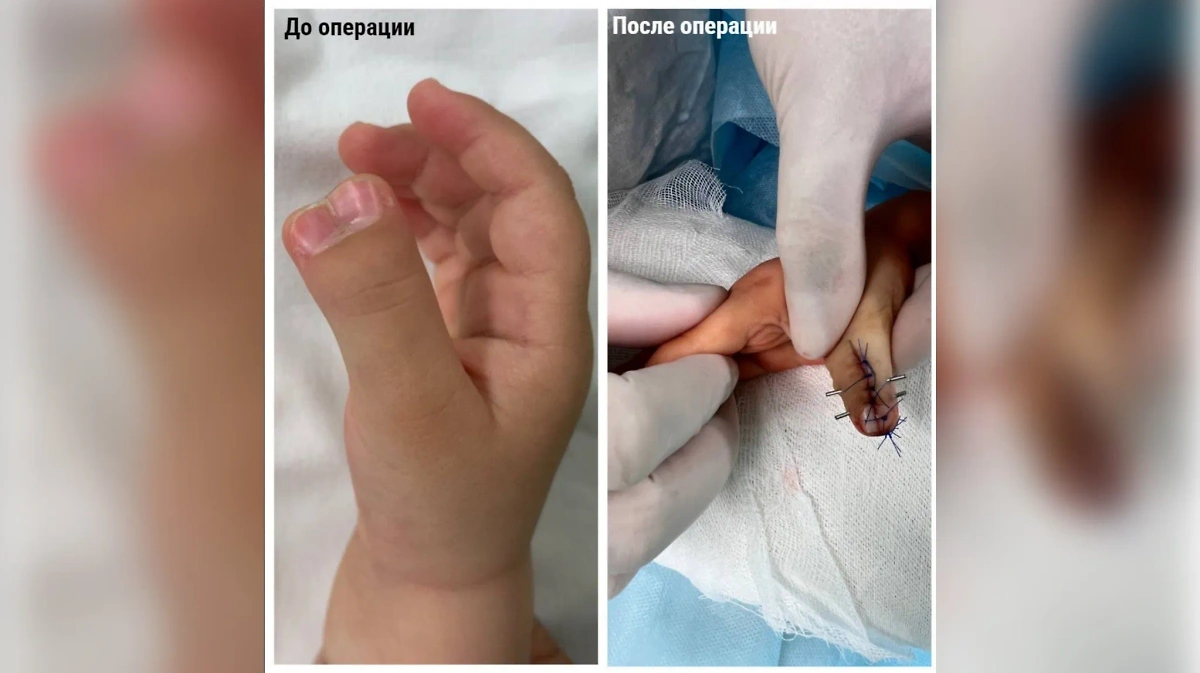 Состояние ребёнка с удвоенным пальцем до и после операции. Фото © Министерство здравоохранения Московской области