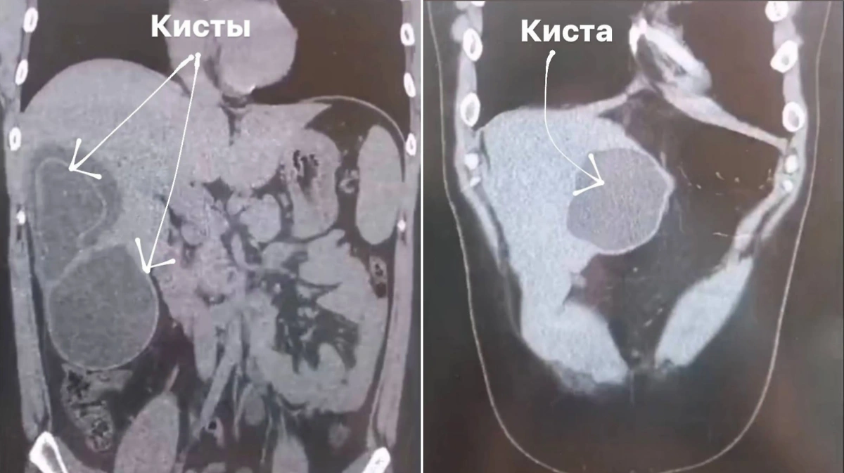 Снимки кист с ленточными червями, которые удалили хирурги Долгопрудненской больницы. Фото © Минздрав Московской области