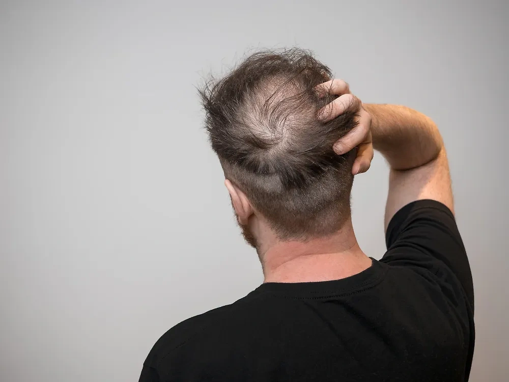 Врач назвала причины выпадения волос. Обложка © Shutterstock / FOTODOM