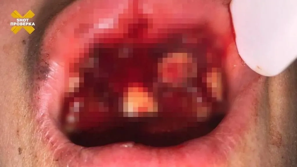 В Уфе электронная сигарета взорвалась во рту у 14-летнего парня. Фото © Telegram / "SHOT ПРОВЕРКА"