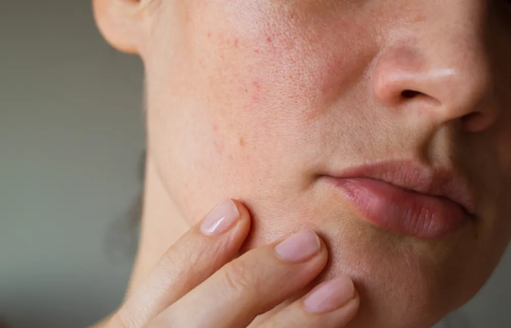 Жирный блеск на коже может говорить о неправильном питании. Обложка © Shutterstock / FOTODOM / Geinz Angelina