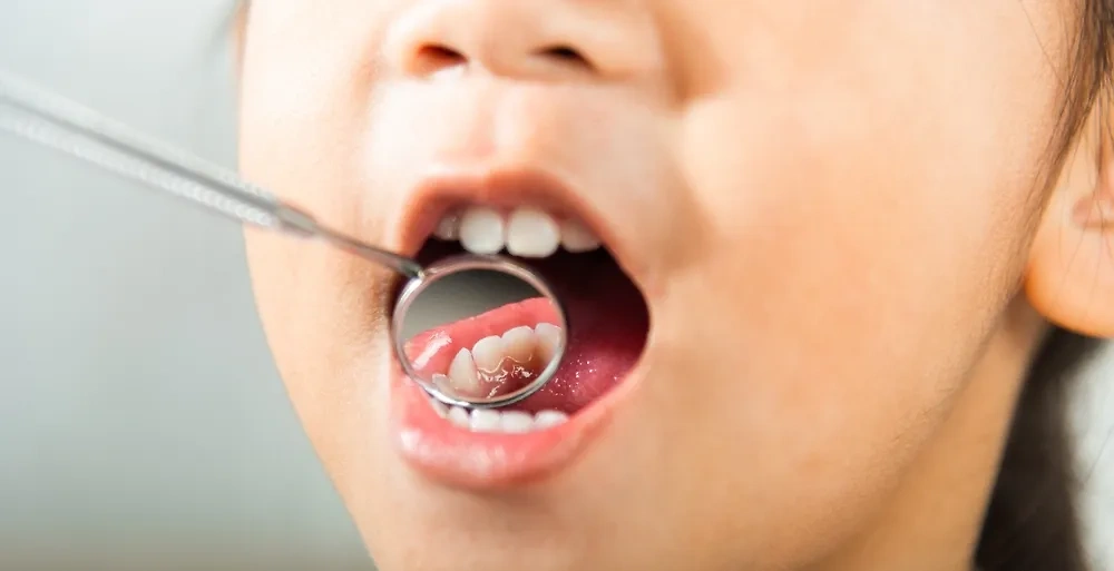 Стоматолог раскрыла, что портит человеческий прикус. Обложка © Shutterstock / FOTODOM / Sorapop Udomsri