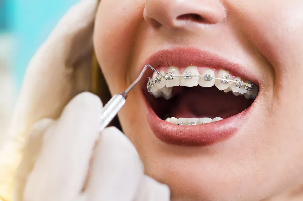 После установки брекетов нужен правильный уход за зубами. Обложка © Shutterstock / FOTODOM / Phoenixns