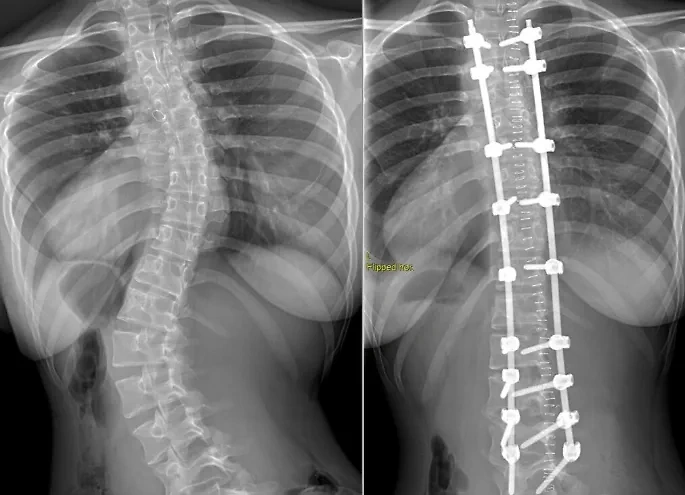 Спина Полины до и после операции. Фото © НИИТО имени Я.Л. Цивьяна