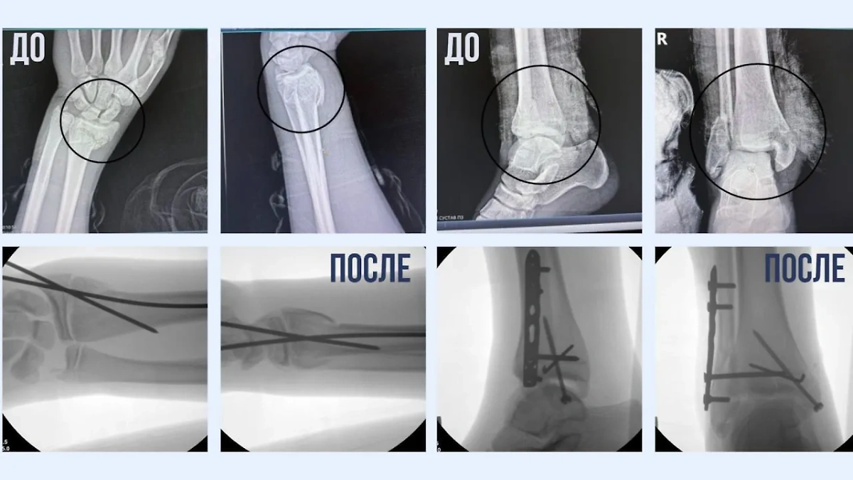 Конечности травмированного подростка до и после лечения врачами в Москве. Фото © Минздрав Московской области