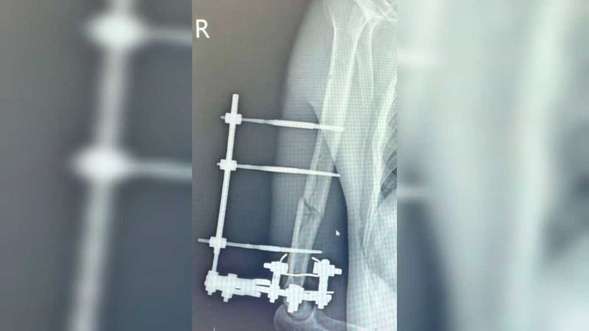 Состояние руки подмосковного мотоциклиста после проведения операции на рентгеновском снимке. Фото © Министерство здравоохранения Московской области