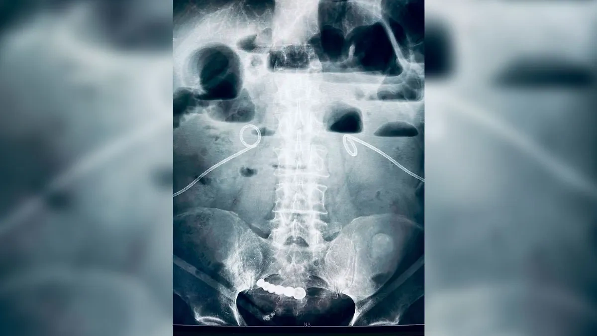 Рентген, на котором видно вставную челюсть в животе пациента. Фото © t.me / Беглов_Zdrav