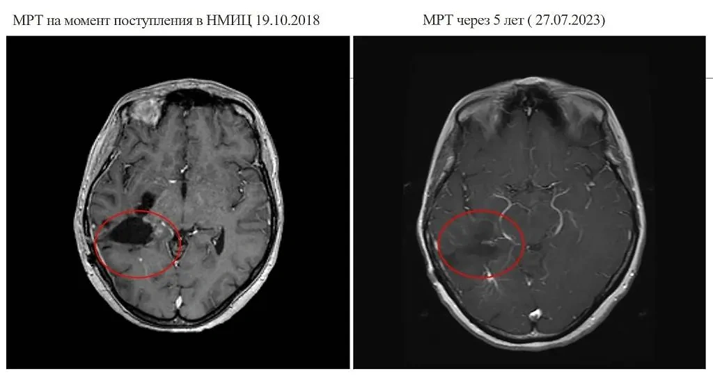 МРТ на момент поступления сибирячки с опухолью в больницу и через пять лет после лечения. Фото © VK / НМИЦ им. ак. Е.Н. Мешалкина Минздрава России