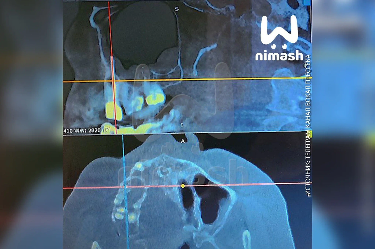 Снимок челюсти. Фото © Telegram / Ni Mash