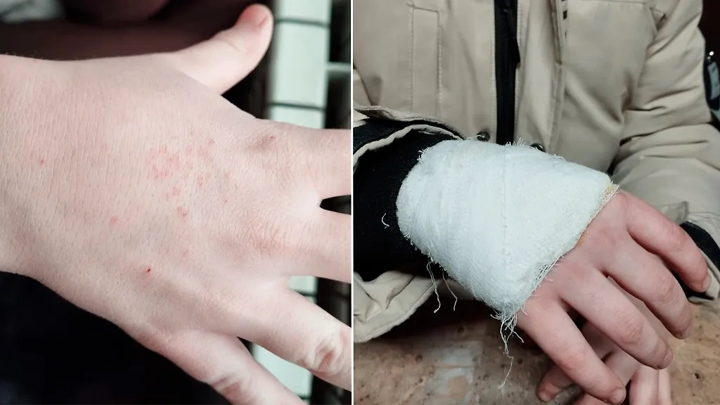 Рука мальчика, которого учительница 27 раз уколола циркулем. Обложка © E1