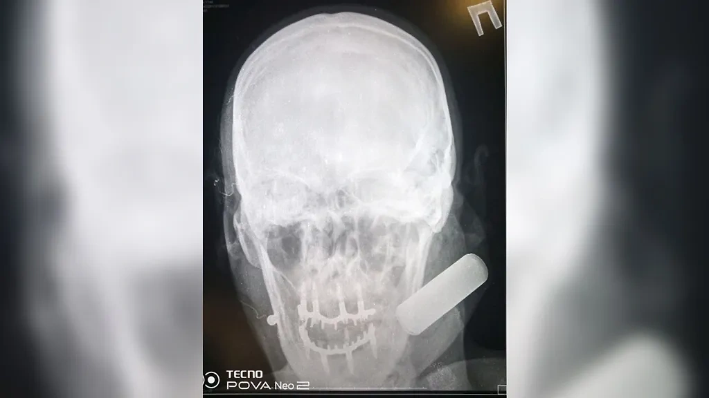 Рентген не прояснил происхождение инородного тела в черепе бойца. Фото © Telegram / Дмитрий Зименкин