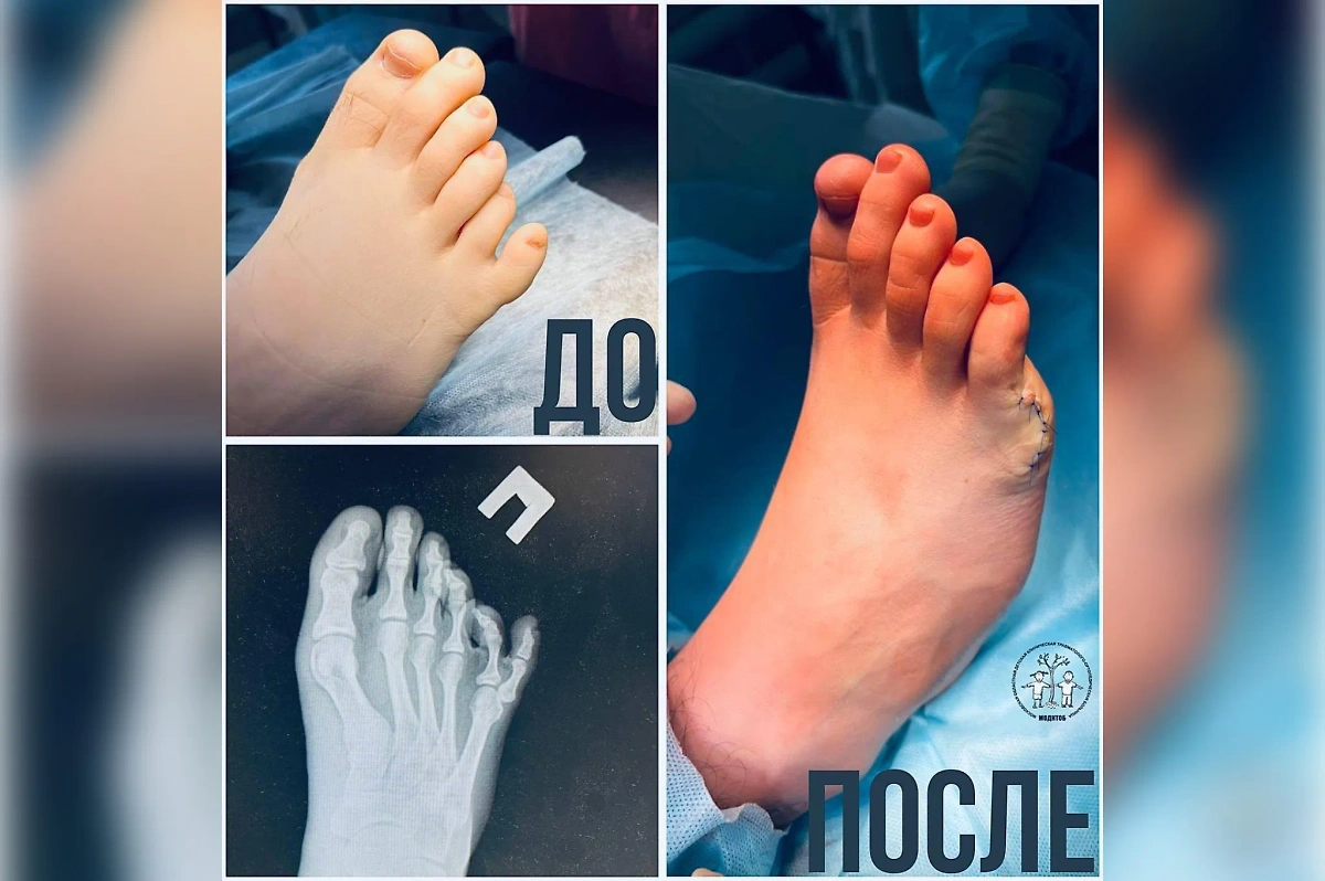 Специалисты МОДКТОБ прооперировали подростка с шестью пальцами на стопе. Обложка © Минздрав Московской области 
