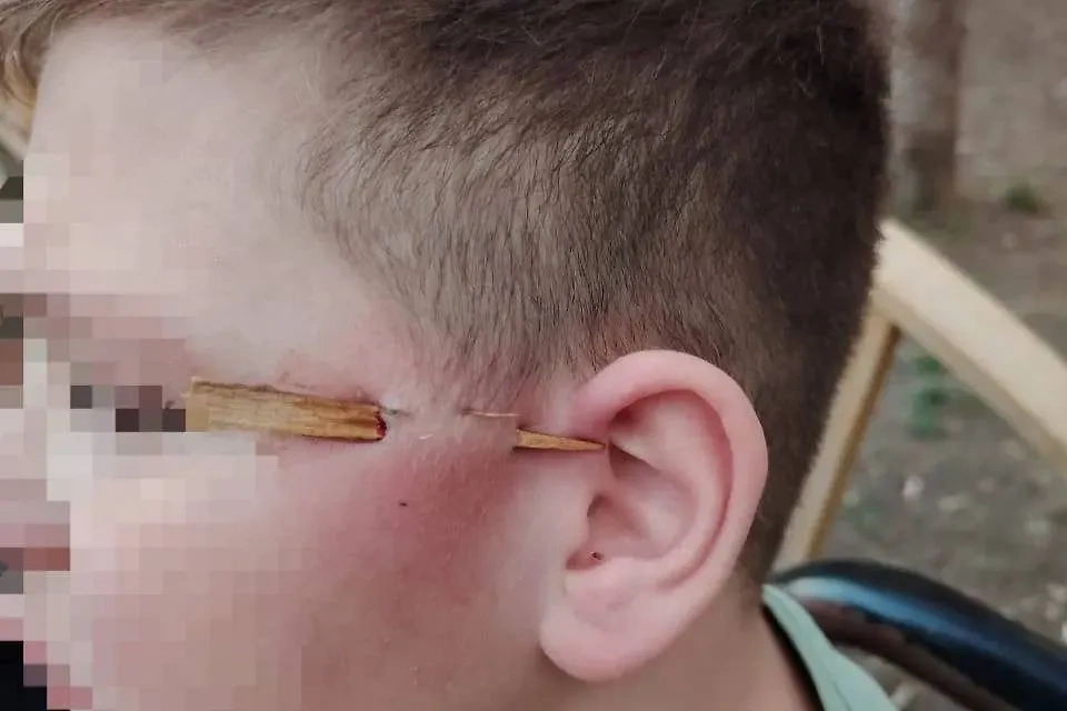 Школьнику проткнули лицо палкой. Обложка © Telegram / Осторожно, Москва