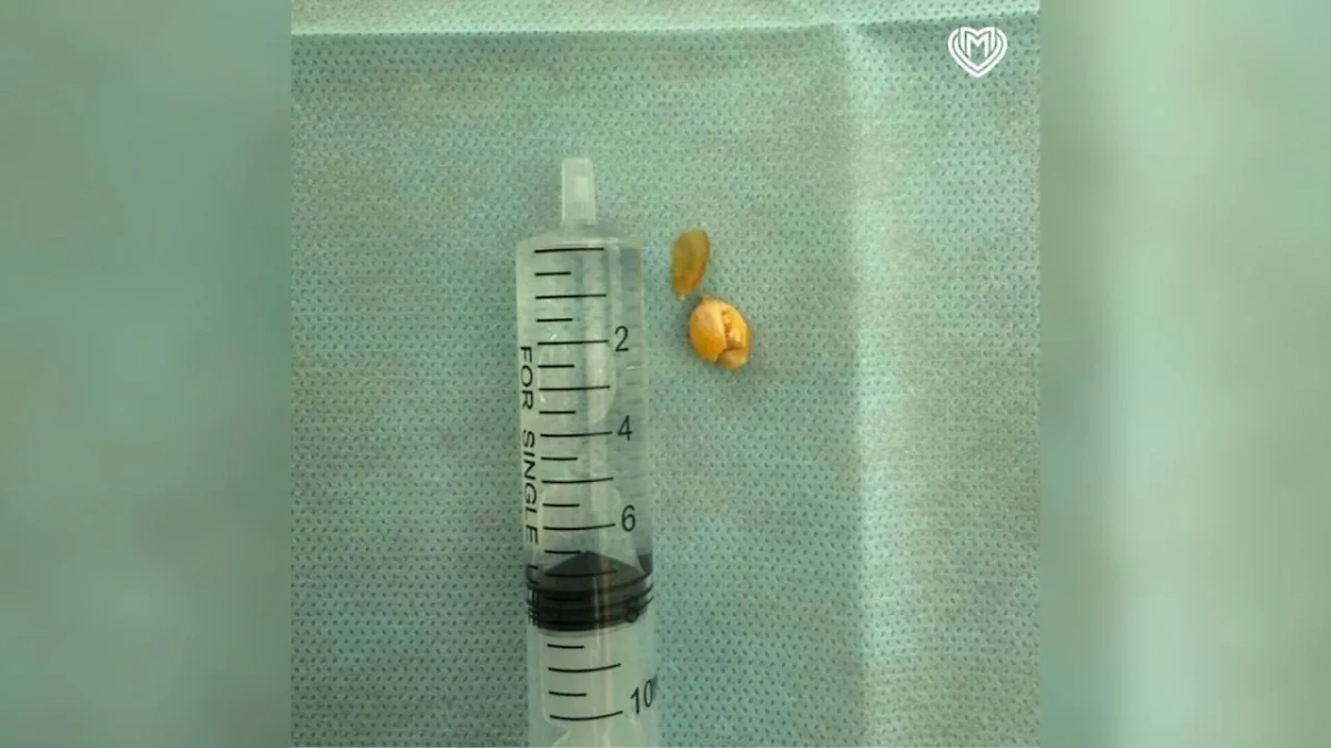 Зёрнышко, которое едва не угробило ребёнка. Фото © Telegram / SHOT