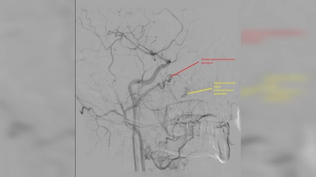 Патологический сброс контрастного вещества (жёлтый). Фото © VK / Орловская областная клиническая больница