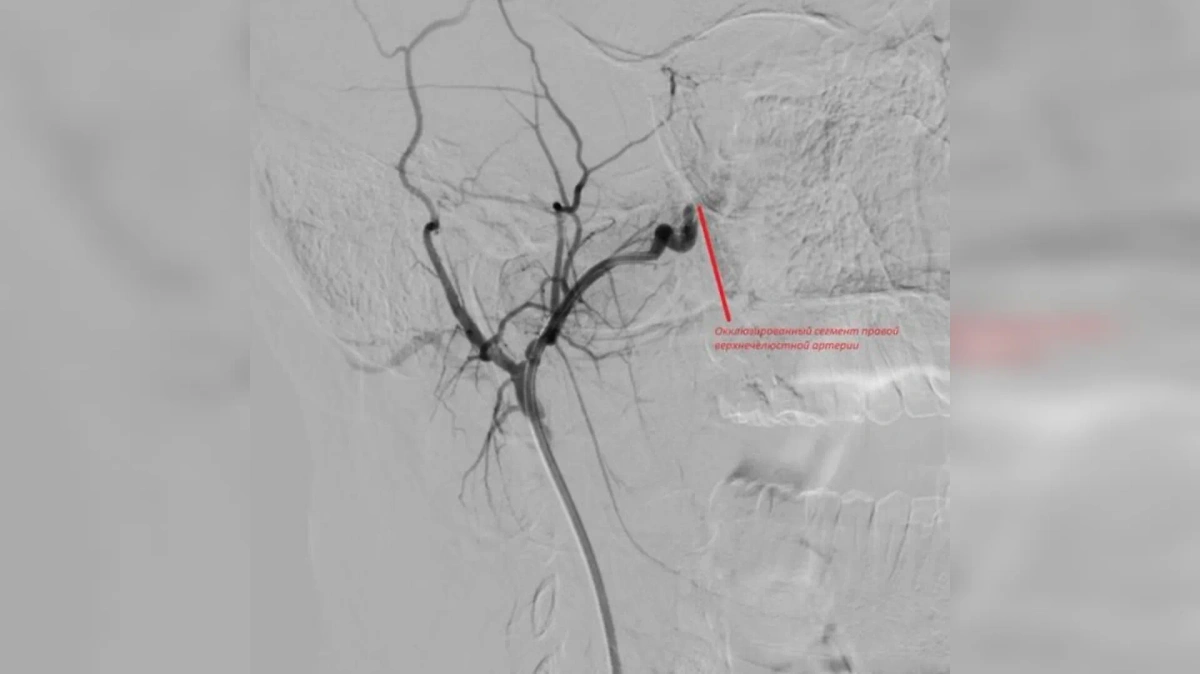 Сегмент правой верхнечелюстной артерии. Фото © VK / Орловская областная клиническая больница