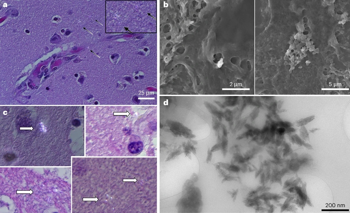 Примеры микропластиковых частиц, обнаруженных в тканях головного мозга. Фото © nature.com