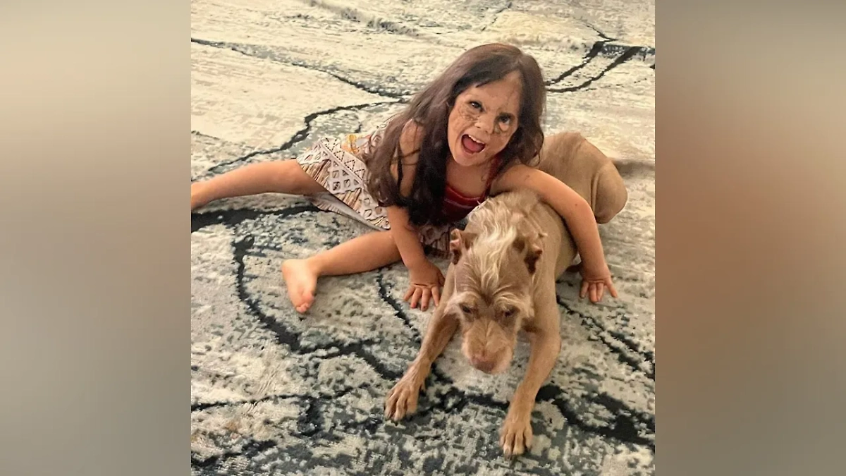 Так выглядит Луна Феннер после ряда операций по удалению негуса на лице. Обложка © Instagram (признан экстремистской организацией и запрещён на территории Российской Федерации) / luna.love.hope