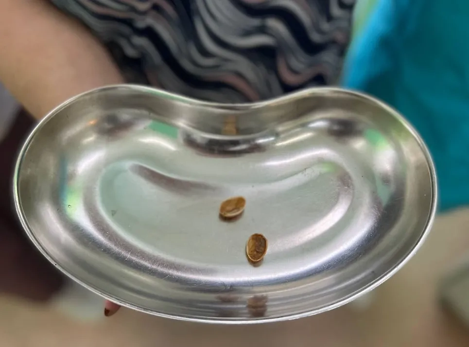 Врачи Подмосковья удалили из бронхов пациентки скорлупу от фисташек. Обложка © Минздрав Московской области