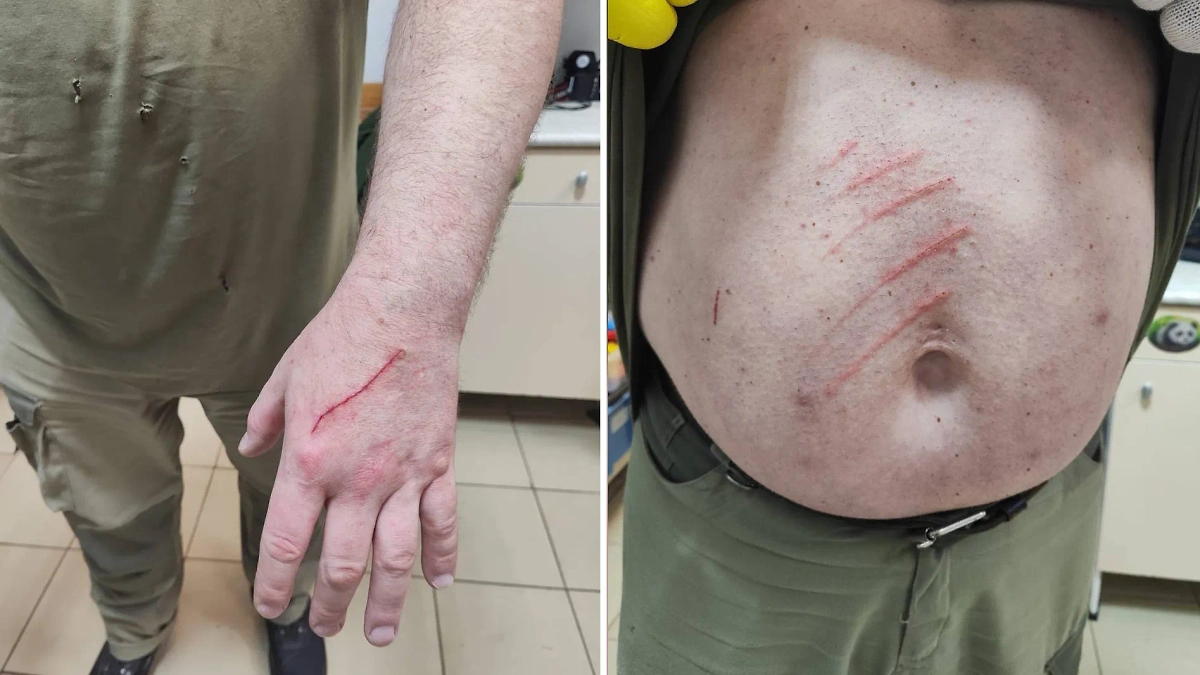 Так выглядят порезы, нанесённые пандой Катюшей сотруднику Московского зоопарка. Фото © Telegram / Светлана Акулова