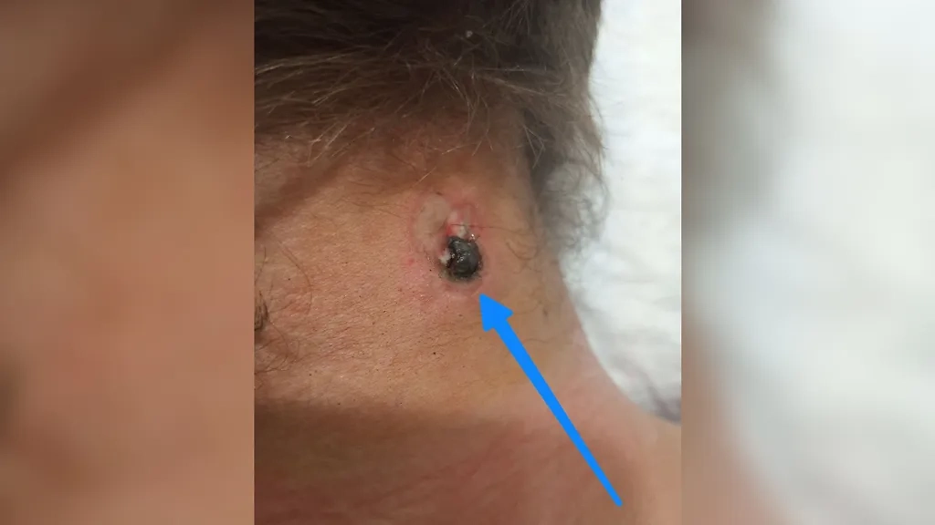 Осколок размером 10х5 мм пробил защиту и застрял в мягких тканях шеи. Фото © Telegram / KUCHITS MED