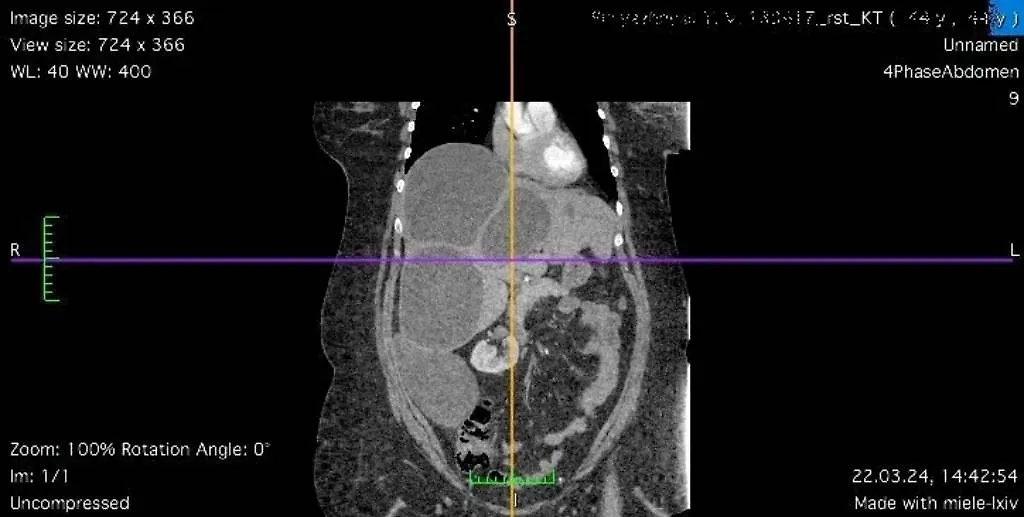Снимок, полученный при проведении спиральной компьютерной томографии у пациентки из Луганска, которую спасли ростовские врачи. Фото © РостГМУ