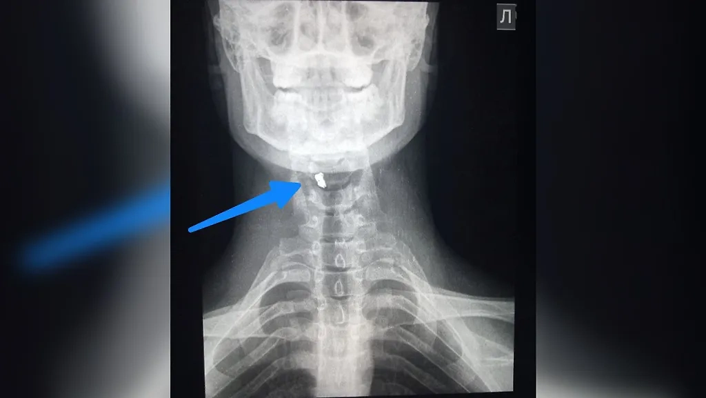 Считаные миллиметры отделяли бойца от гарантированной смерти или тяжелейшей инвалидности. Фото © Telegram / KUCHITS MED