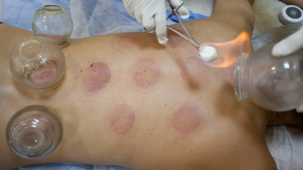 Советские медицинские банки: удивительный метод лечения. Фото © ТАСС / Павел Головкин